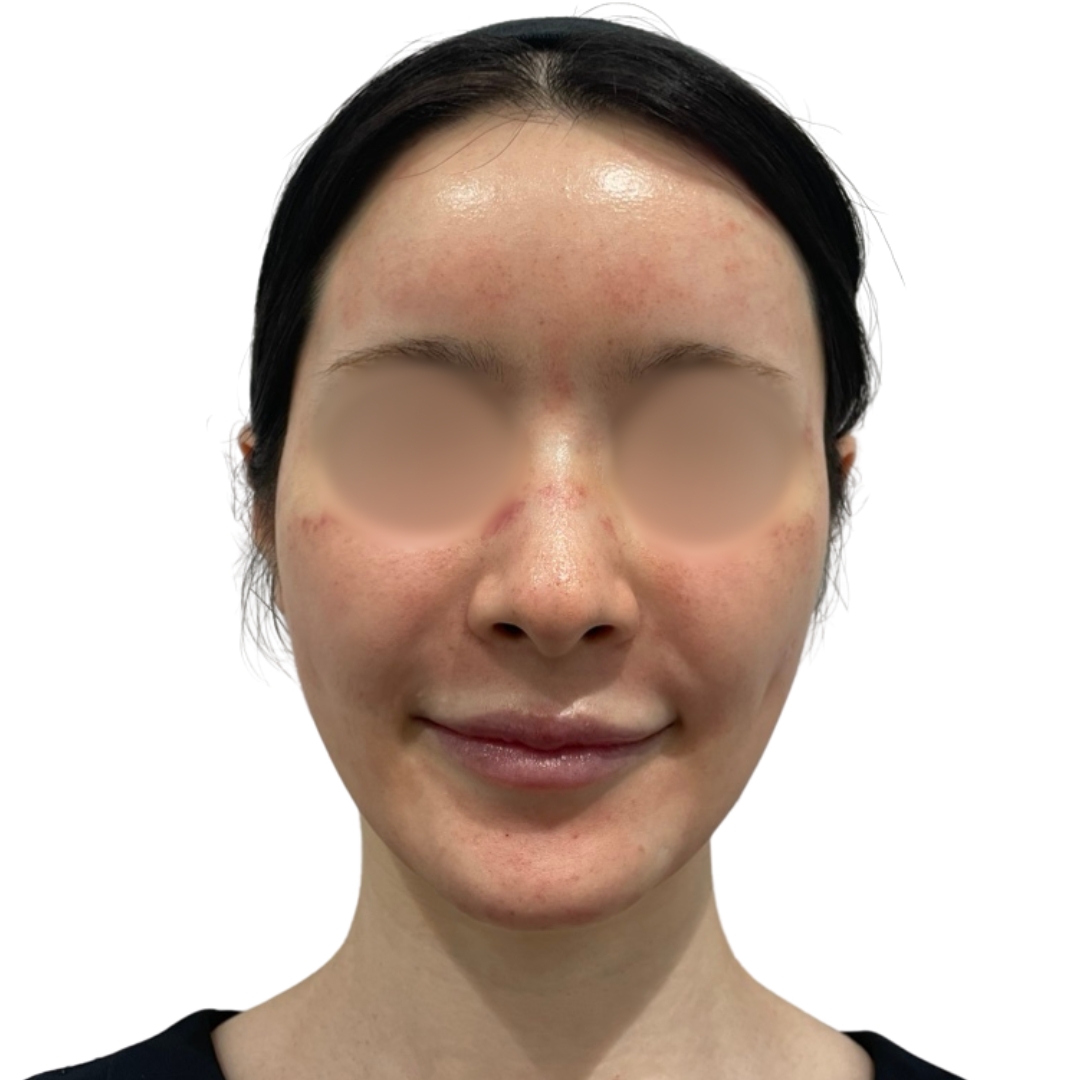 エクソソームフェイシャル